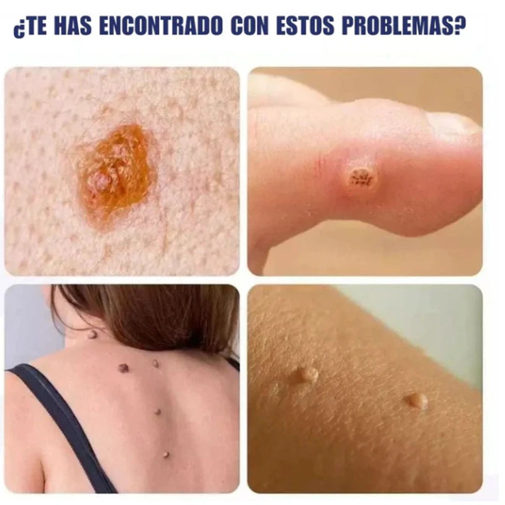 Kit Removedor de Verrugas South Moon – Líquido Natural + Crema para Eliminar Verrugas + Aplicadores