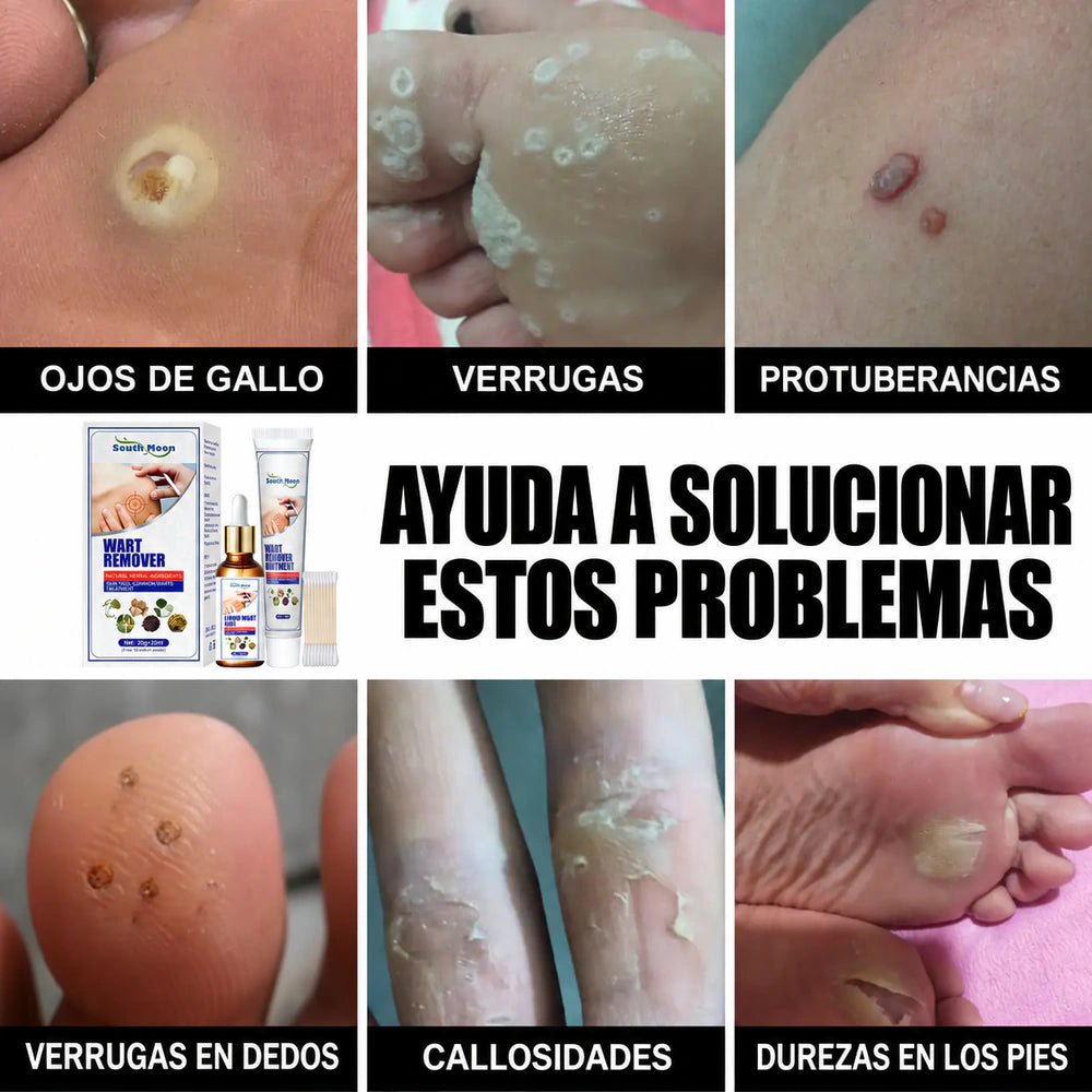 Kit Removedor de Verrugas South Moon – Líquido Natural + Crema para Eliminar Verrugas + Aplicadores