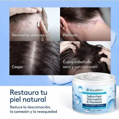 Crema para eliminar hongos, seborrea, dermatitis e infecciones del cuero cabelludo