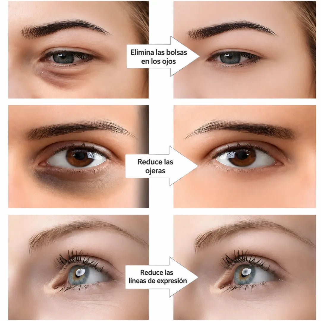 Quítate 5 Años de Encima y Borra las Ojeras en 14 Días, Sin Inyecciones Dolorosas ni Capas de Maquillaje