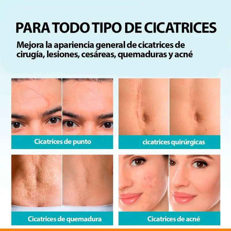Spray De Cicatrices - Desaparece las Cicatrices en 90 días