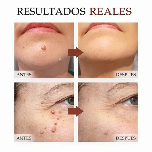 Sérum + crema para verrugas: Elimina las arrugas desde la raíz
