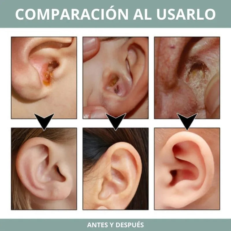 Earwax Off® - Elimina el cerumen y las infecciones al instante