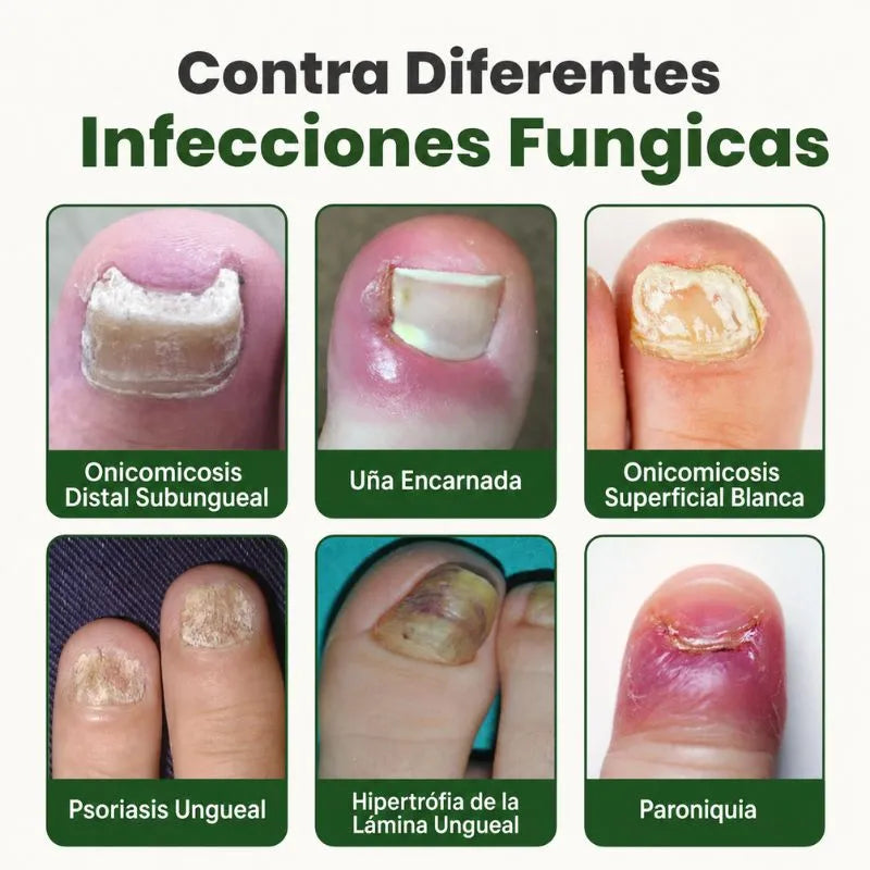 Fungix Pro - Protege y elimina el hongo de tus uñas con ingredientes 100% naturales