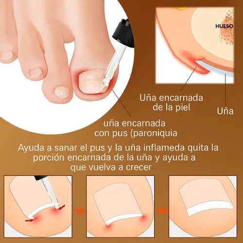 Protege y elimina el hongo de tus Uñas (PAGA 1 Y LLEVA 3 UNIDADES)