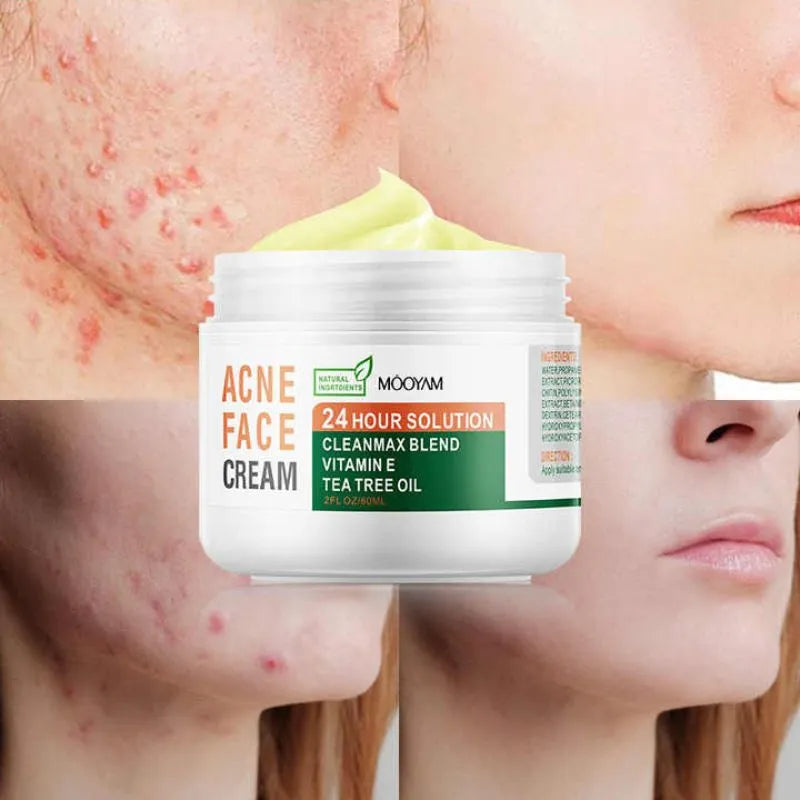 Crema Antiacne 24 Horas (2 Unidades)